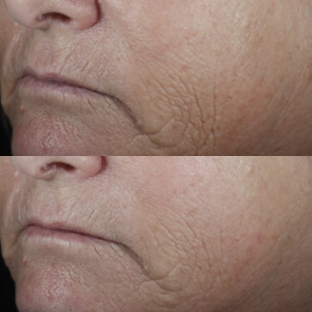 Perricone MD Neuropeptide Smoothing Facial Conformer-anti-aging, brighten, Vegan - Picture 5 of 5